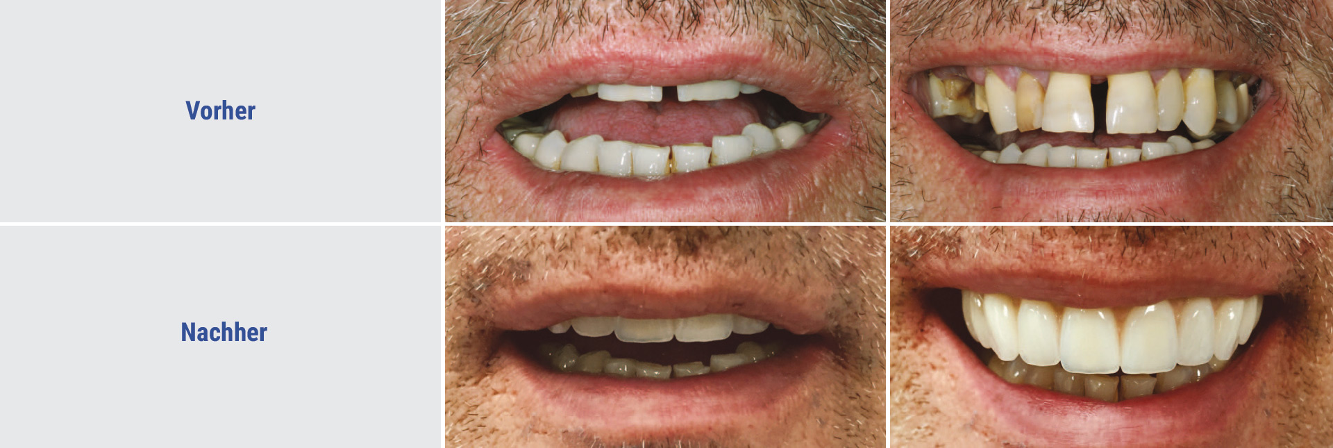 Vorher Nachher