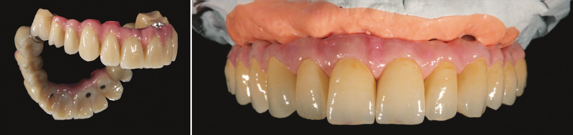 fest verschraubte Brücke