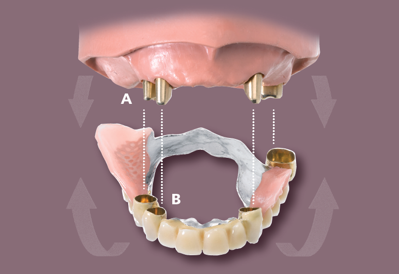 Gaumenplatte mit zahnprothese oberkiefer Herausnehmbarer Zahnersatz
